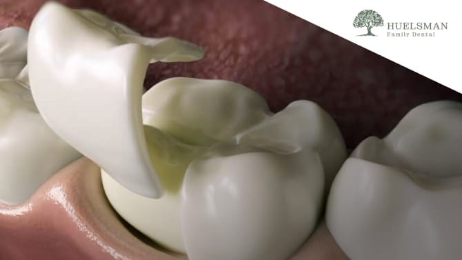 3d illustration of onlays teeth