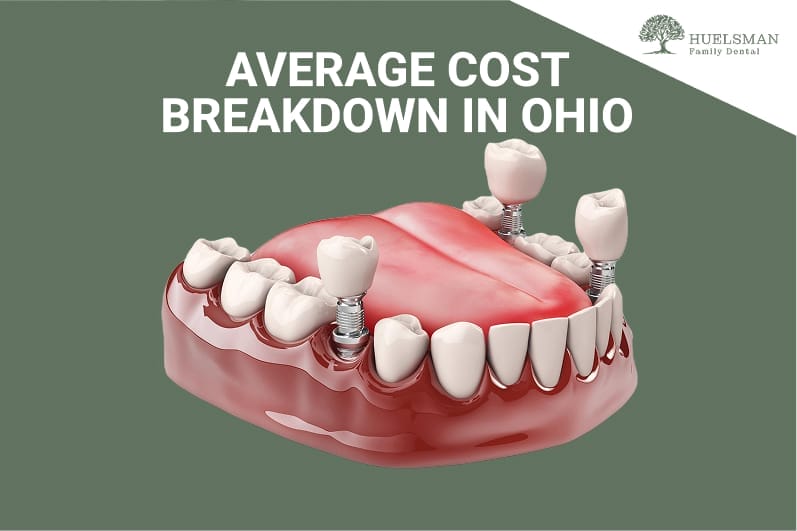 text: average cost breakdown of implant in ohio